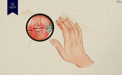 dau-hieu-benh-gout-o-tay