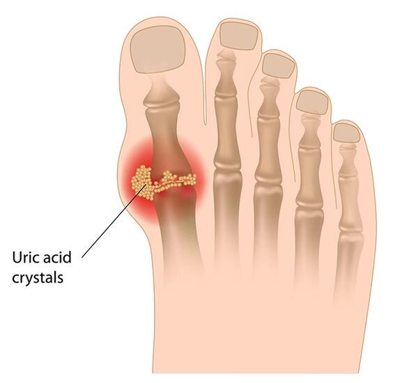 Axit uric không được đào thải hết ra khỏi cơ thể sẽ lắng đọng tại các khớp. Chúng chuyển hóa thành tinh thể muối urat, gây viêm, sưng đau ở các khớp chân, tay.