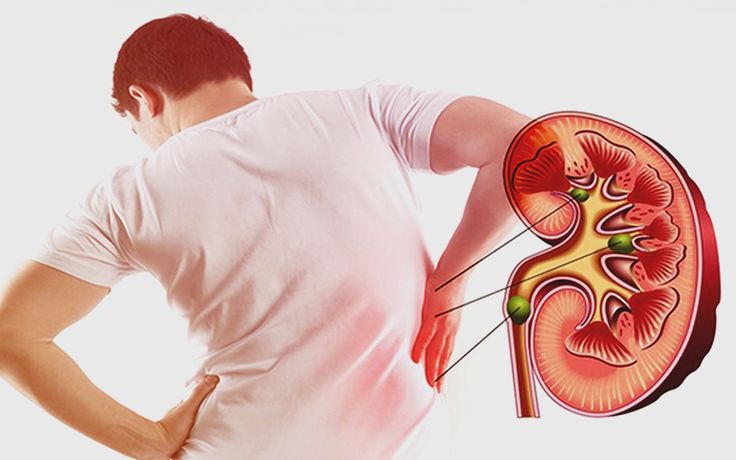 Các tinh thể urate tích tụ trong thận gây sỏi thận và ảnh hưởng đến hoạt động lọc chất thải ra khỏi cơ thể của cơ quan này