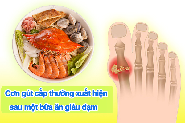Gút là bệnh phải kiêng cữ nhiều thứ