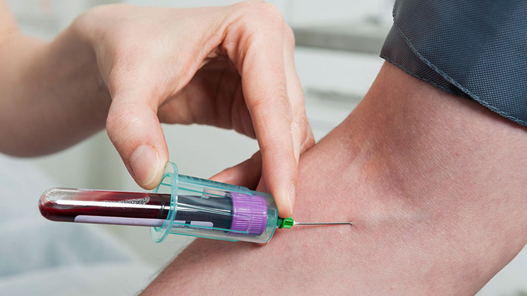 Chỉ số Axit Uric cao bao nhiêu thì bị Gout?