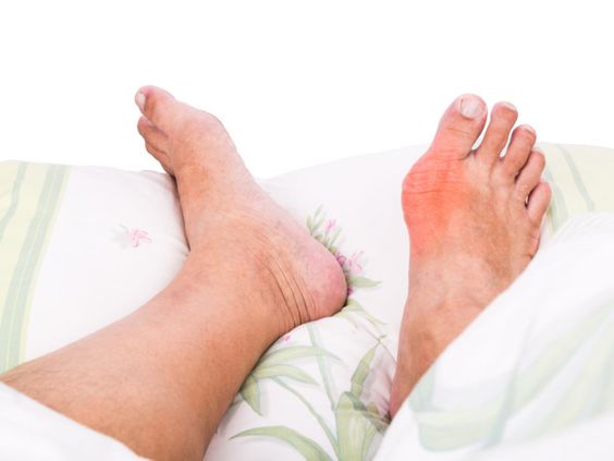 Bạn hoàn toàn có thể chữa được bệnh gout bằng cây thuốc nam